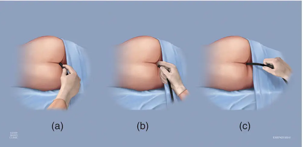 Figure 612 Rectal intubation techniques This illustration demonstrates the - фото 63