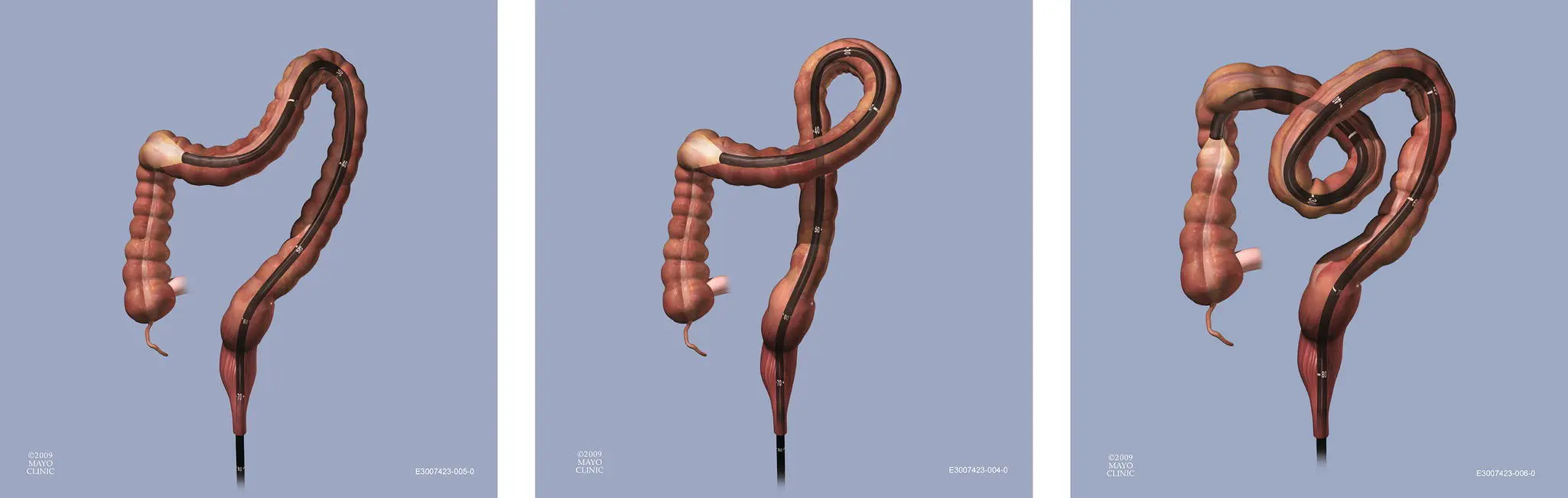 Figure 626 Transverse colon loop Like the sigmoid the transverse colon is - фото 81