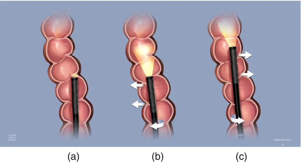 Figure 628 Torque to open folds When less acute turns are encountered the - фото 85