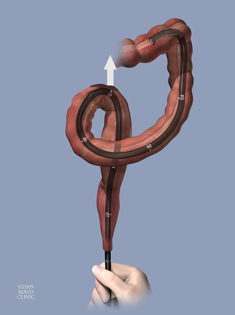 Figure 620 Looping causing perforation In this sigmoid loop the scope is - фото 72