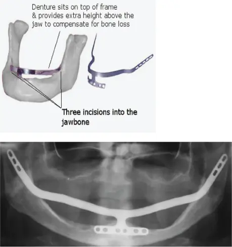 Figure 13 Ramus implants Figure 14 Mandibular tranossteal implant The key - фото 4