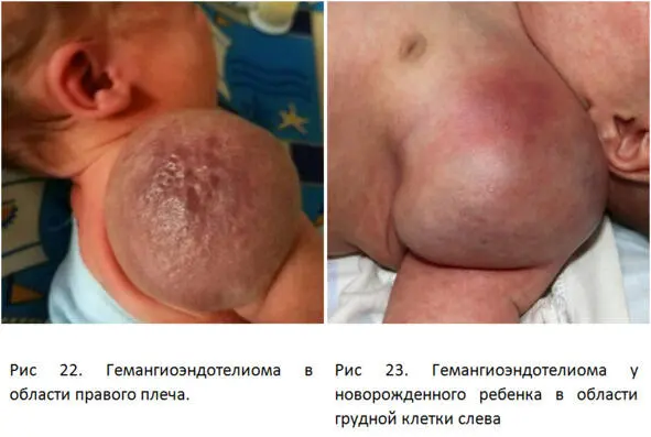 У 71 пациентов с данной сосудистой опухолью выявляется жизнеугрожающий синдром - фото 16