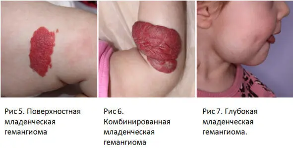 По площади поражения младенческие гемангиомы разделяют на очаговыепоражение - фото 8
