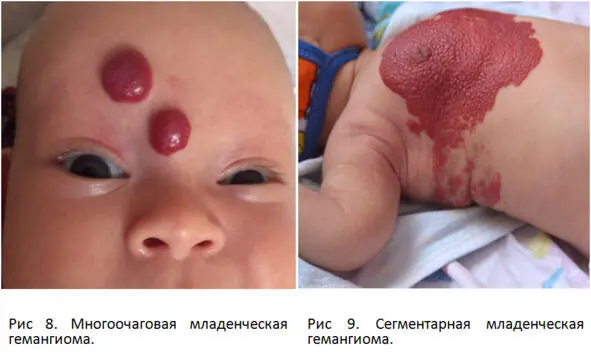 18 Что такое врожденная гемангиома Врожденная гемангиома отличается от - фото 9
