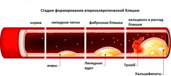 Рис 1 Стадии формирования атеросклеротической бляшки По мере созревания - фото 1