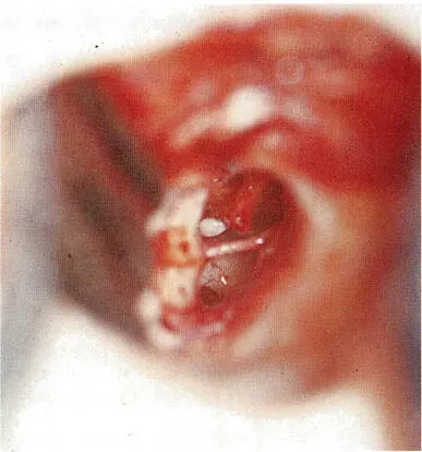 b Abb 318 a Traumatische Trommelfellperforation mit blutigimbibierten - фото 51