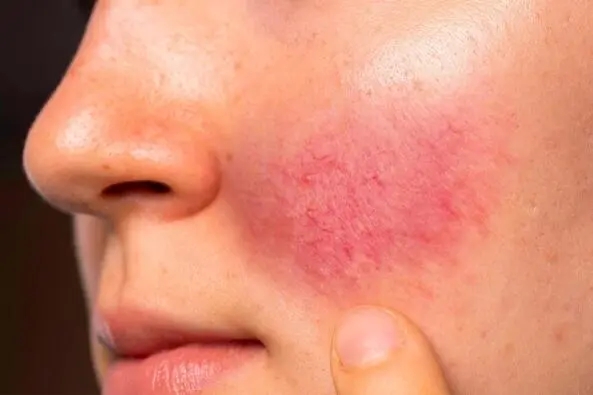 Bei der Rosacea auch Rosazea handelt es sich um eine chronisch verlaufende - фото 3