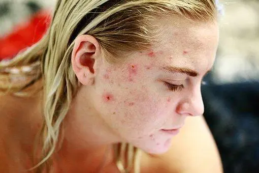 Schweregrad I Acne comedonica Charakteristika Pickel Komedonen - фото 2