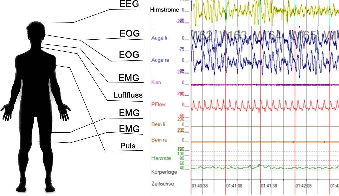Mittels Elektroenzephalographie EEG können Gehirnwellen verschiedener - фото 1