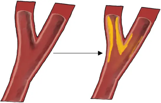 Figure 28 Formation of plaques in the common carotid artery and internal - фото 11