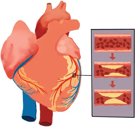 Figure 29 Plaque formation in the heart arteries The data captured by a CT - фото 12