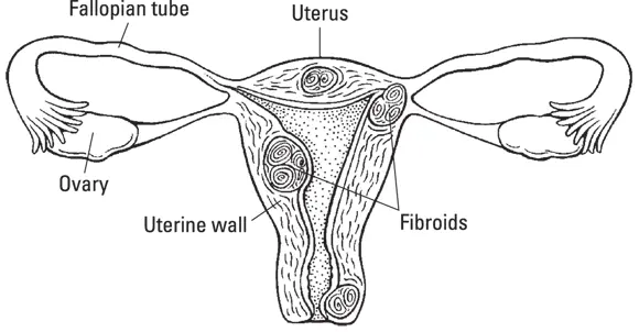 Illustration by Kathryn Born MA FIGURE 23Fibroids uterine growths - фото 31