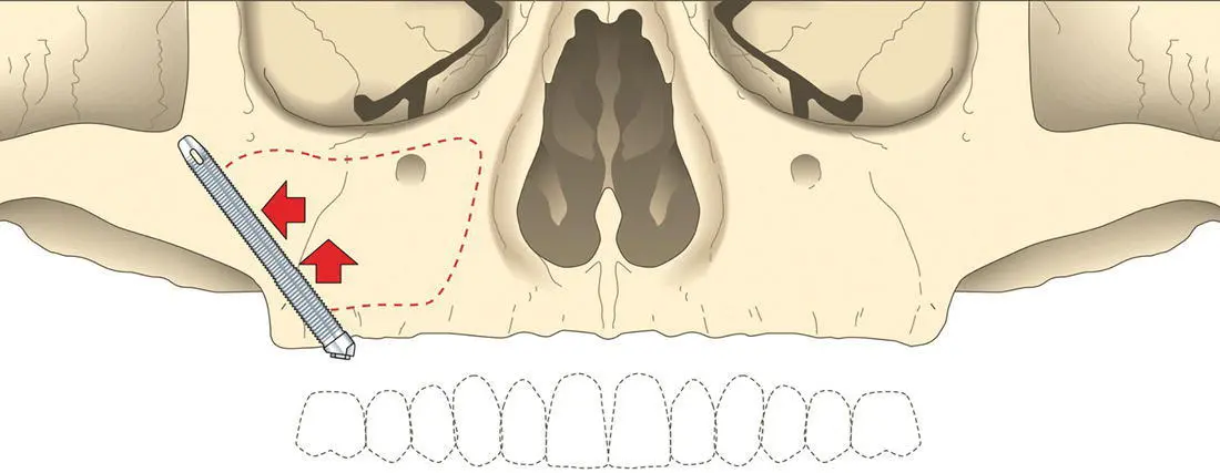 Figure 116 Zygoma implants Courtesy of Nobel Biocare After the implant is - фото 19