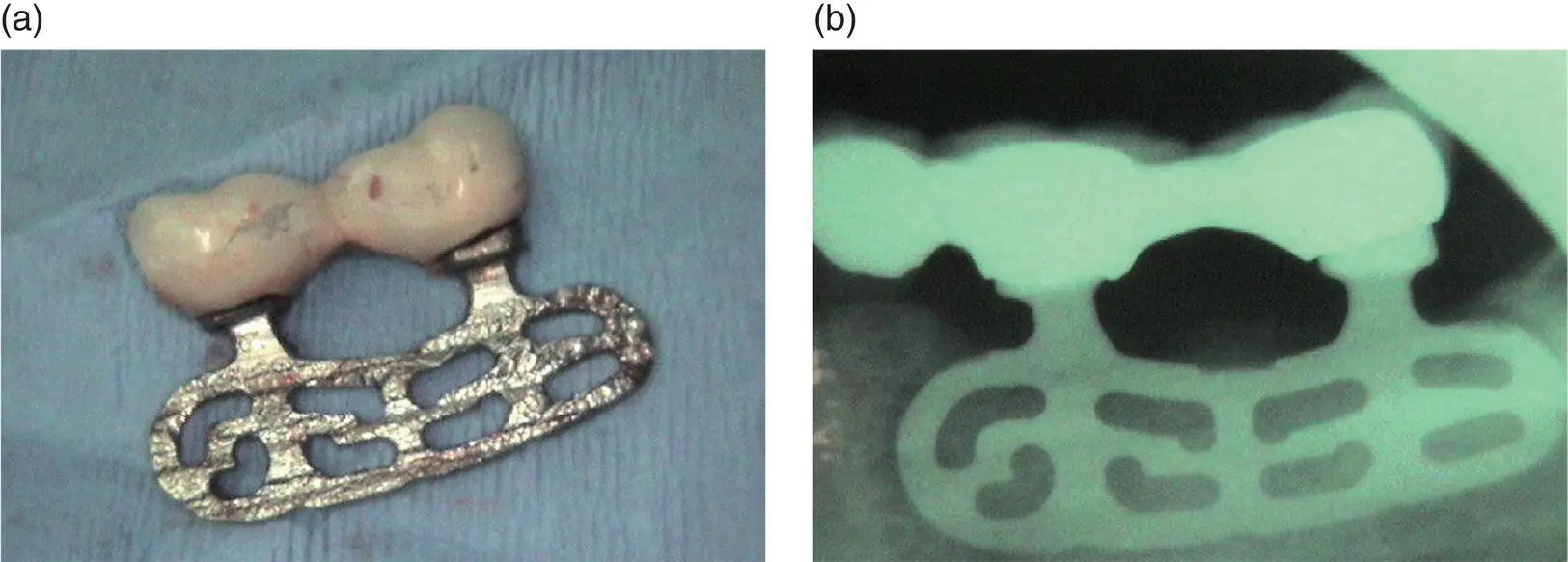 Figure 113 Bladeform implants Courtesy of Dr Frank Wingrove Figure 114 - фото 16