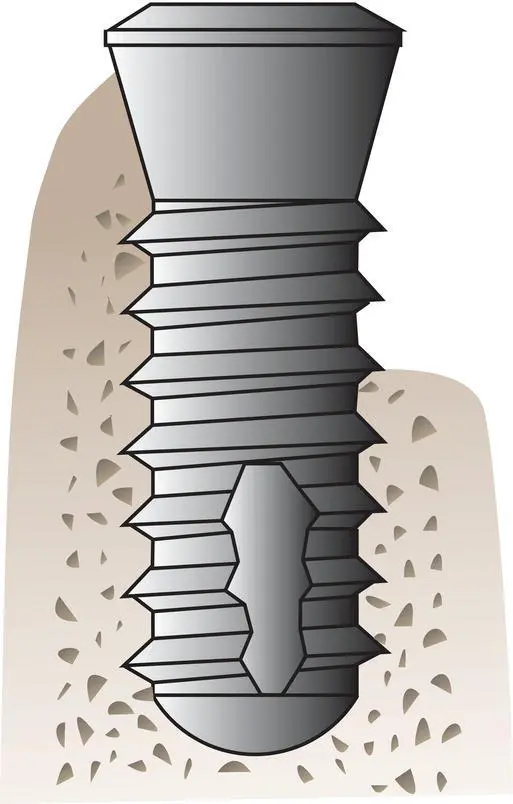 Figure 114 Endosteal rootform implants Reprinted from Taylor and Laney 23 - фото 17