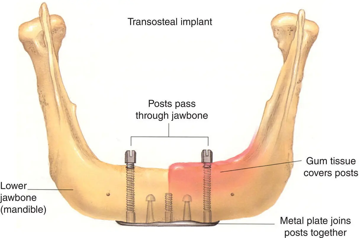 Figure 112 Transosteal implant Reprinted from Taylor and Laney 23 with - фото 15