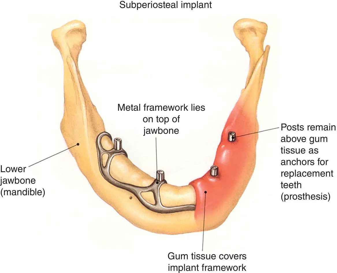 Figure 111 Subperiosteal implant Reprinted from Taylor and Laney 23 with - фото 14