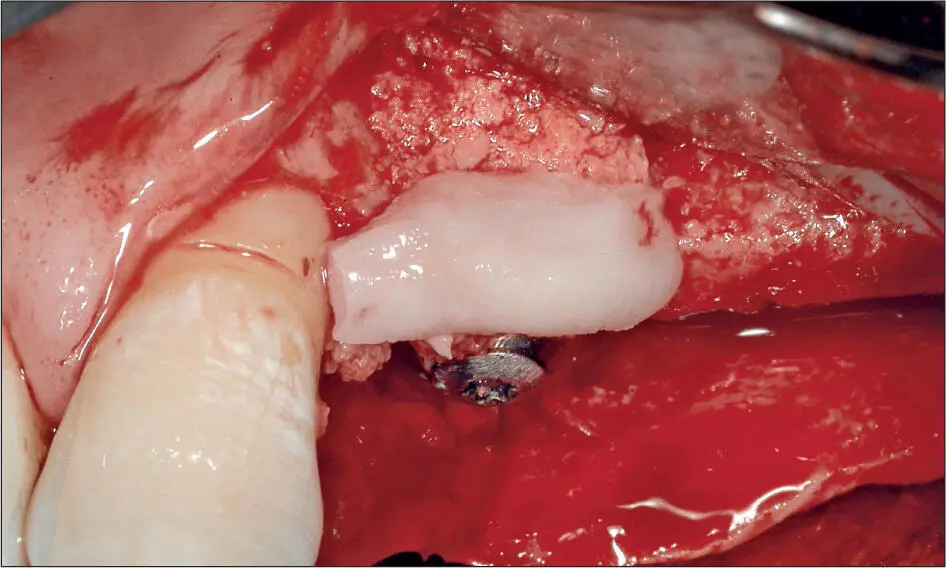 Abb 4 g Autologe Knochenspäne auf der vestibulären Implantatseite Zum Schutz - фото 37