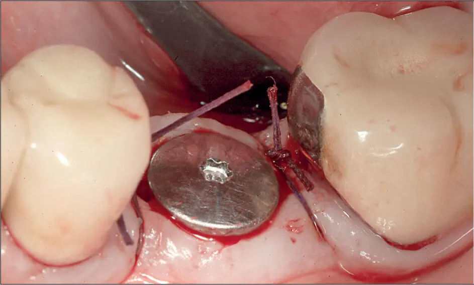 Abb 3 g Das Weichgewebe wurde rings um den glatten Implantatkragen so - фото 28