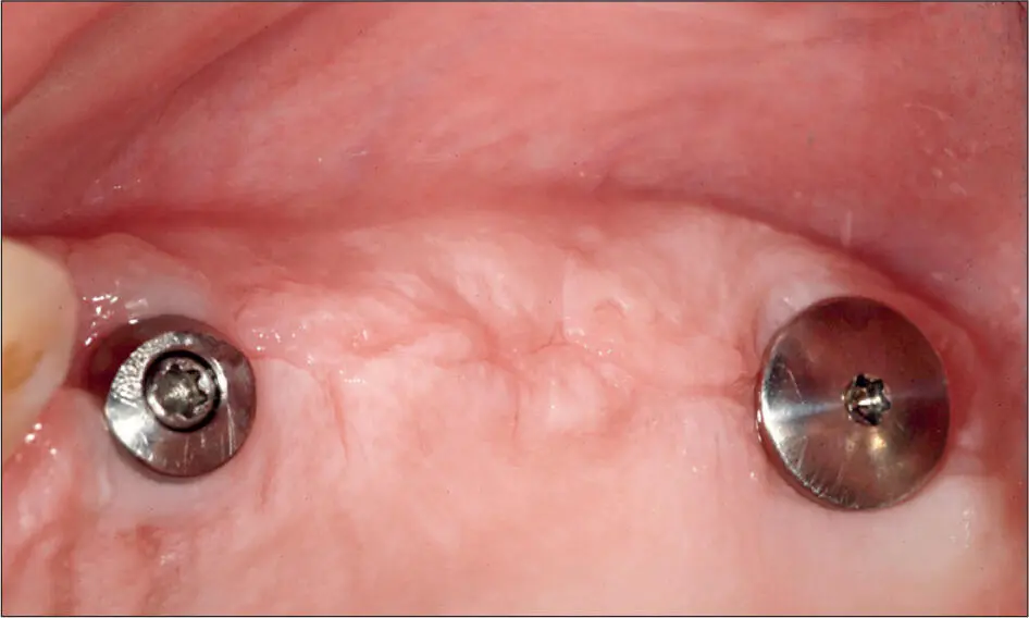 Abb 4 i Zustand 6 Wochen nach dem Implantationseingriff mit optimal - фото 39