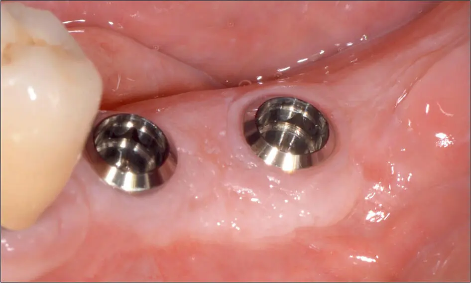 Abb 9 o Zustand 3 Monate nach dem Eingriff Die Implantate sind von einem - фото 91