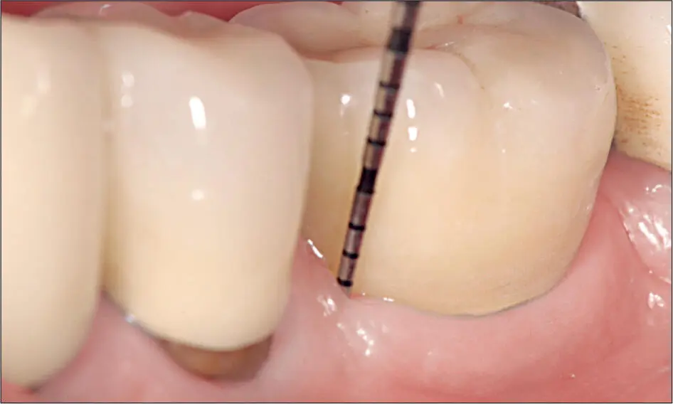 Abb 3 i 7 Jahre nach Insertion zeigt das periimplantäre Weichgewebe trotz - фото 30