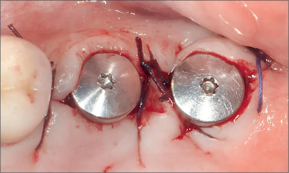Abb 5 h Zustand nach dem endgültigen Vernähen distal zum distalen Implantat - фото 51