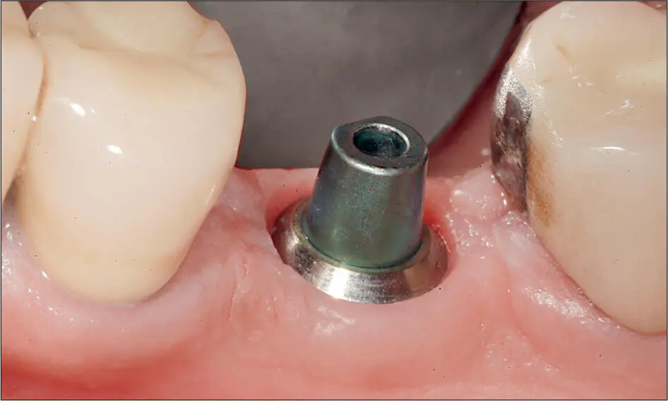 Abb 3 h Zustand 3 Monate nach Insertion Das Implantat ist von einem festen - фото 29