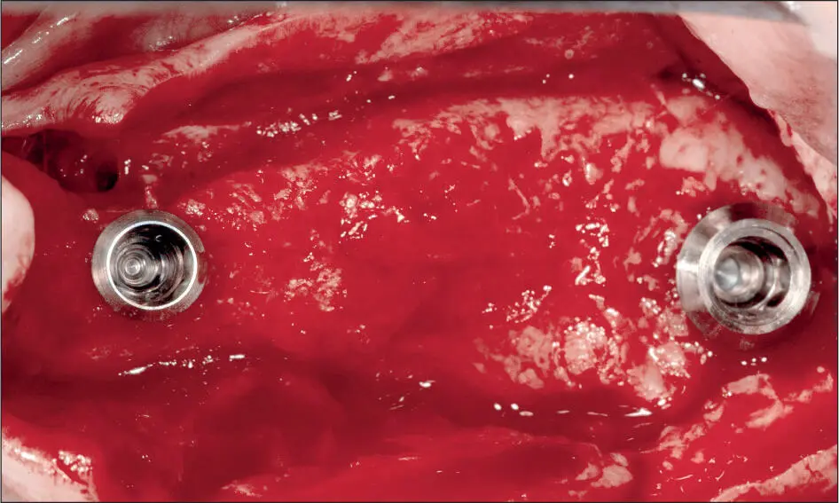 Abb 4 f Intraoperative Ansicht nach der Implantation in Regio 24 SP WNI - фото 36