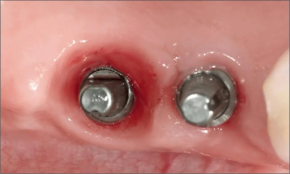 Abb 2 a Zustand mit tiefem Schleimhauttrichter rund um ein Implantat distal - фото 20