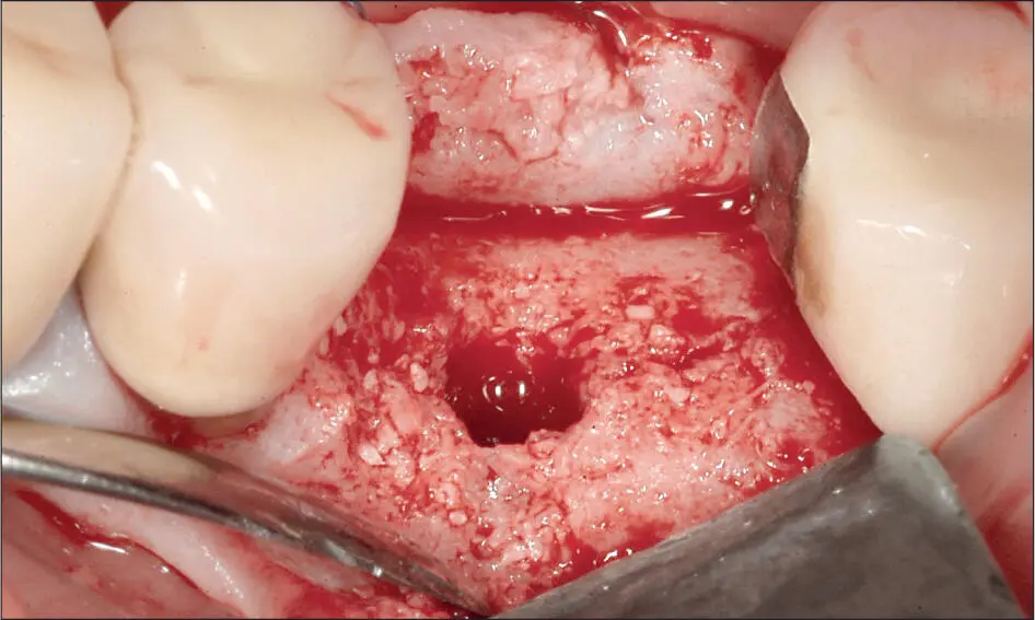 Abb 3 e Nach 4 Monaten war der Alveolarkamm ohne weiteren Augmentationsbedarf - фото 26