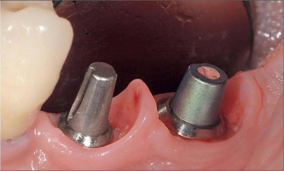 Abb 1 b Gesunde Interdentalpapille zwischen zwei TissueLevelImplantaten - фото 19