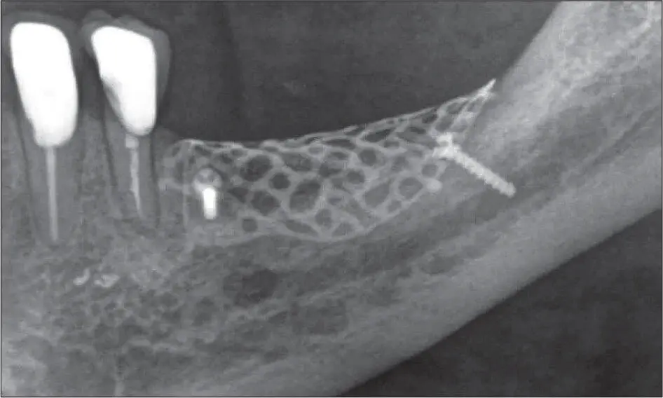 Abb 9 l Röntgenansicht des augmentierten Areals vor dem Implantationseingriff - фото 88