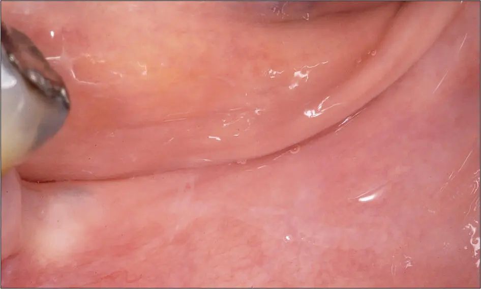Abb 8 a Ausgangssituation mit Knochenatrophie und einer sehr gewebeschwachen - фото 70