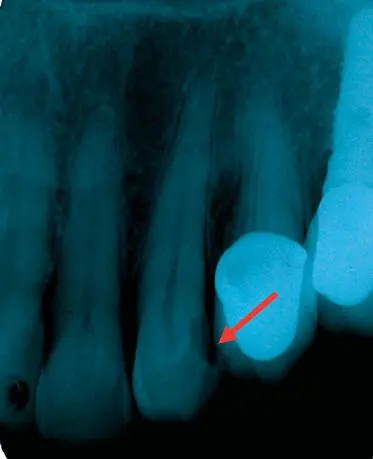 Figura 44Radiografía periapical donde se observa sombra radiolúcida en distal - фото 55