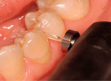 Figura 420La punta con bisel posibilita la detección de caries en proximal - фото 71