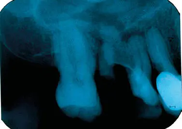 Figura 29Radiografía intraoral periapical donde se observa una sombra - фото 24