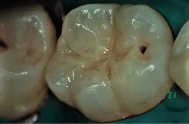 Figura 34Lesión en fosa mesial del 16 Figura 35El concepto de - фото 30