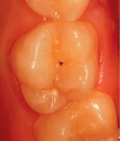 Figura 12Se observa caries en oclusal del 26 Figura 13Aplicando ozono - фото 10