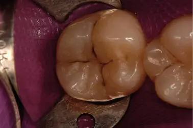 Figura 21En la cara oclusal del 47 se observa lesión de caries en el - фото 16