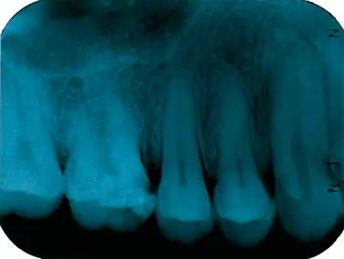 Figura 49Radiografía periapical en la que se observa una zona radiolúcida en - фото 60