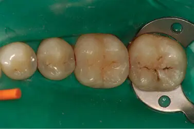 Figura 24Surcos pigmentados o remineralizados en 34 35 y 36 En 37 se - фото 19