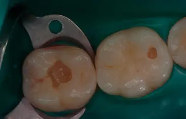 Figura 36Como se observa en la imagen en las piezas dentarias 47 en - фото 32