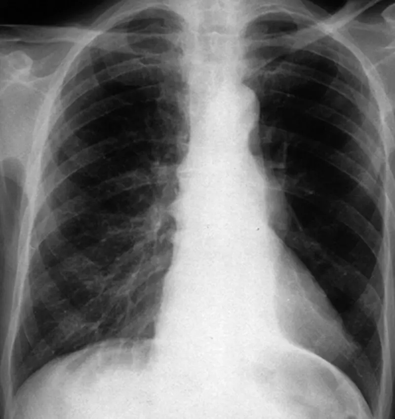Figure 44 Left lower lobe collapse The left lower lobe has collapsed medially - фото 49