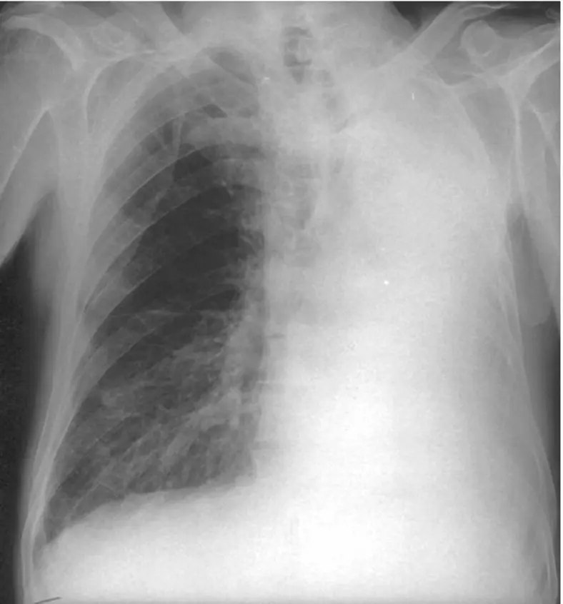 Figure 45 Left lung collapse There is complete opacification of the left - фото 50