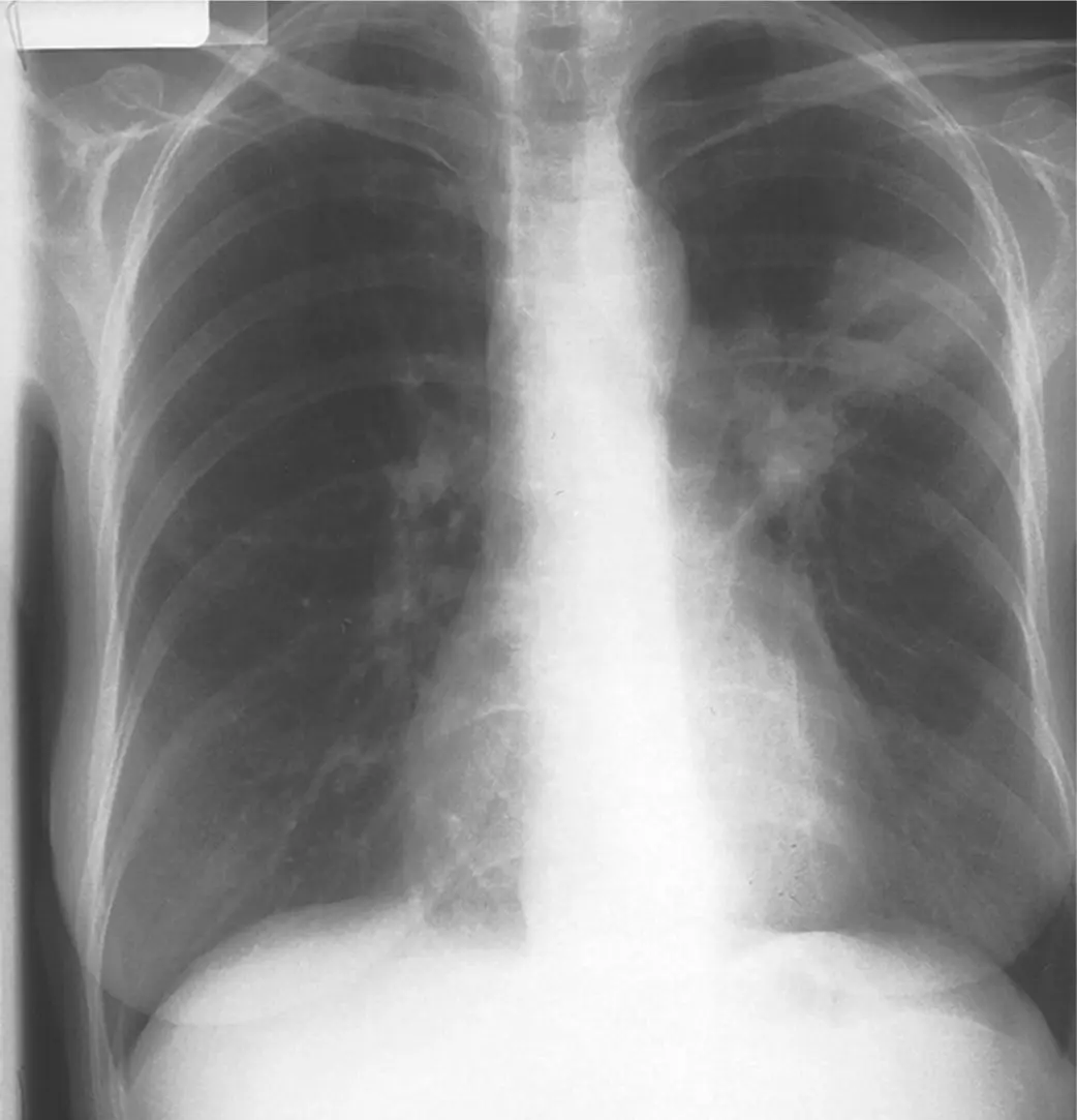 Figure 48 A cavitating lesion in the left upper lobe A cavity appears as an - фото 53