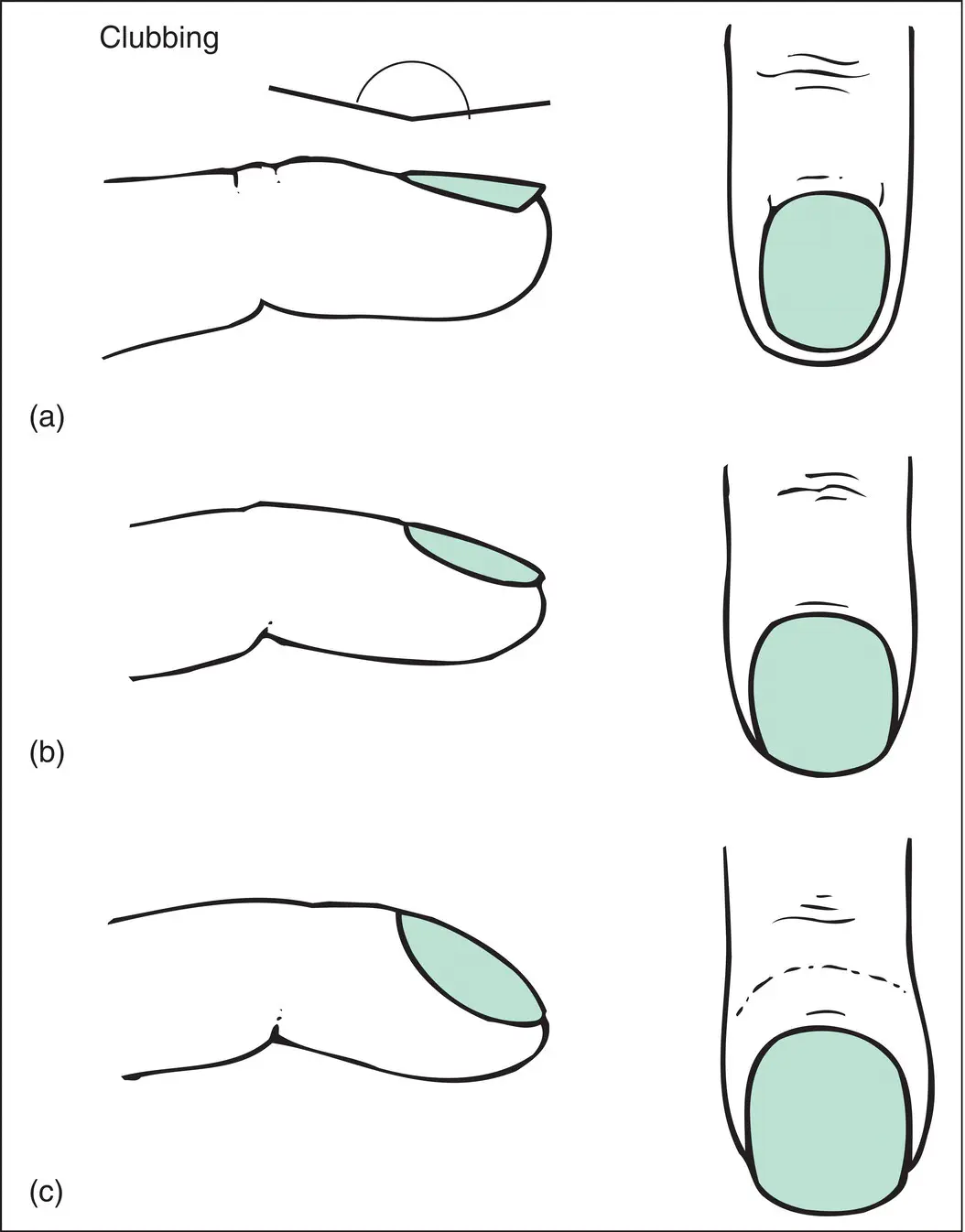 Figure 22 Clubbing a Normal the angle is shown b Early the angle is - фото 24
