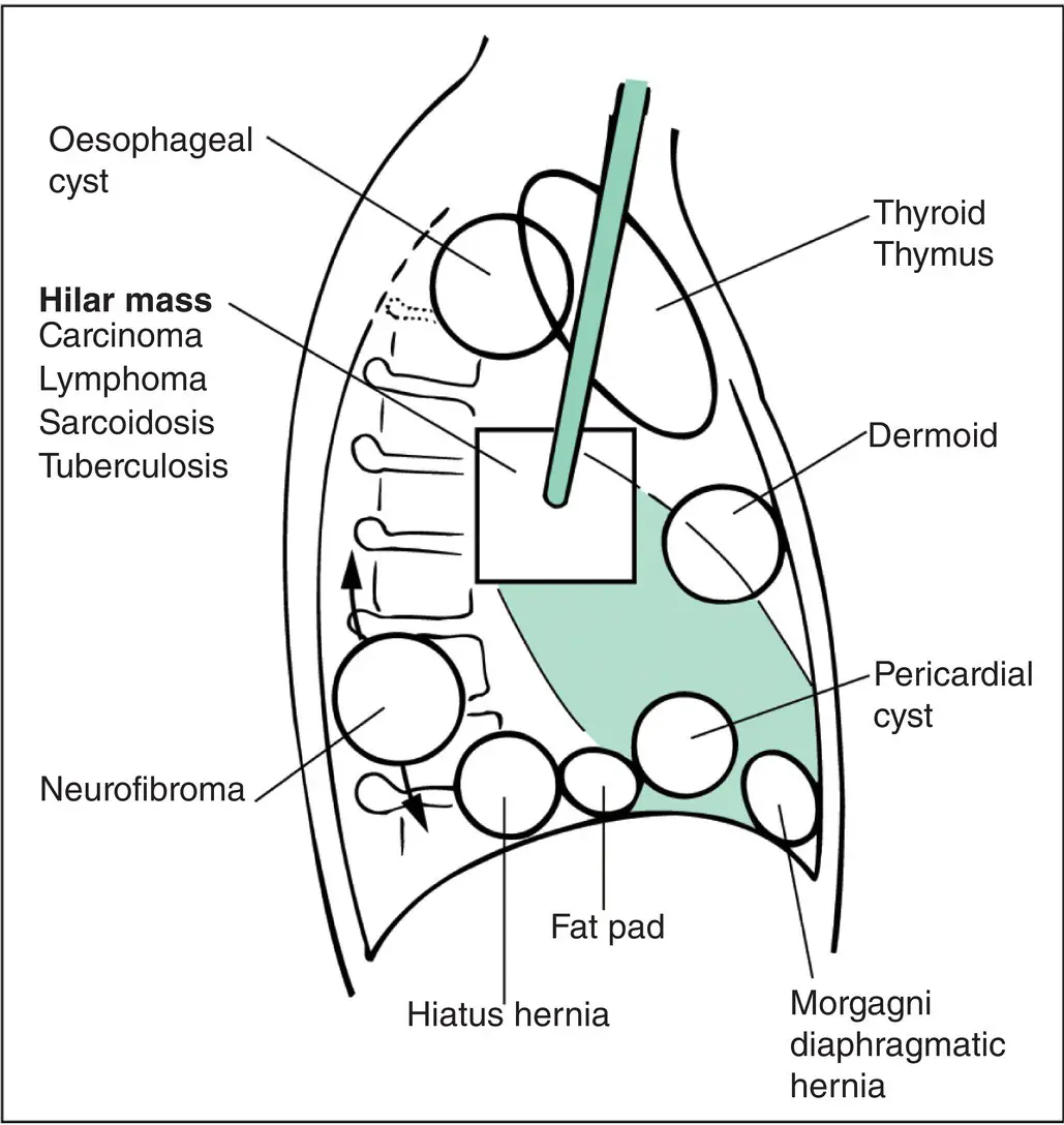 Figure 49 Mediastinal masses Diagram of lateral view of the chest indicating - фото 54