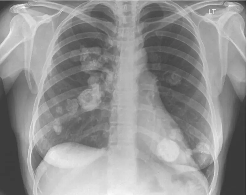Figure 47 Chest Xray showing multiple partially calcified rounded masses in - фото 52