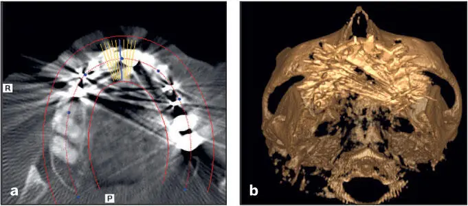 Fig 59 a Horizontal slice of a CBCT demonstrating scatter from metallic - фото 92